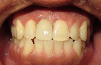 Implant After
